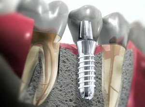 denti sani a Bari con l'implantologia a bari